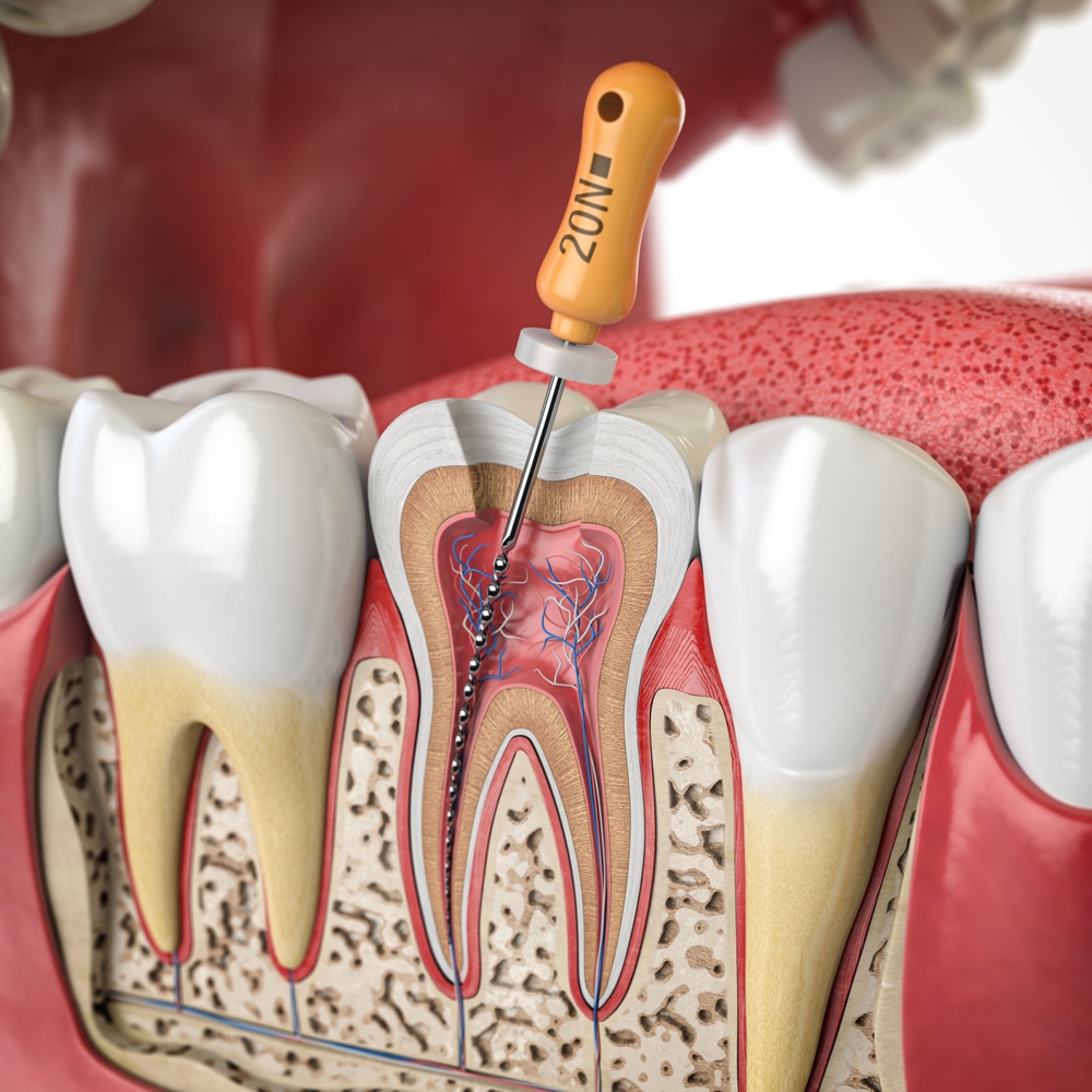 Endodontie dentaire - Traitement des canaux radiculaires