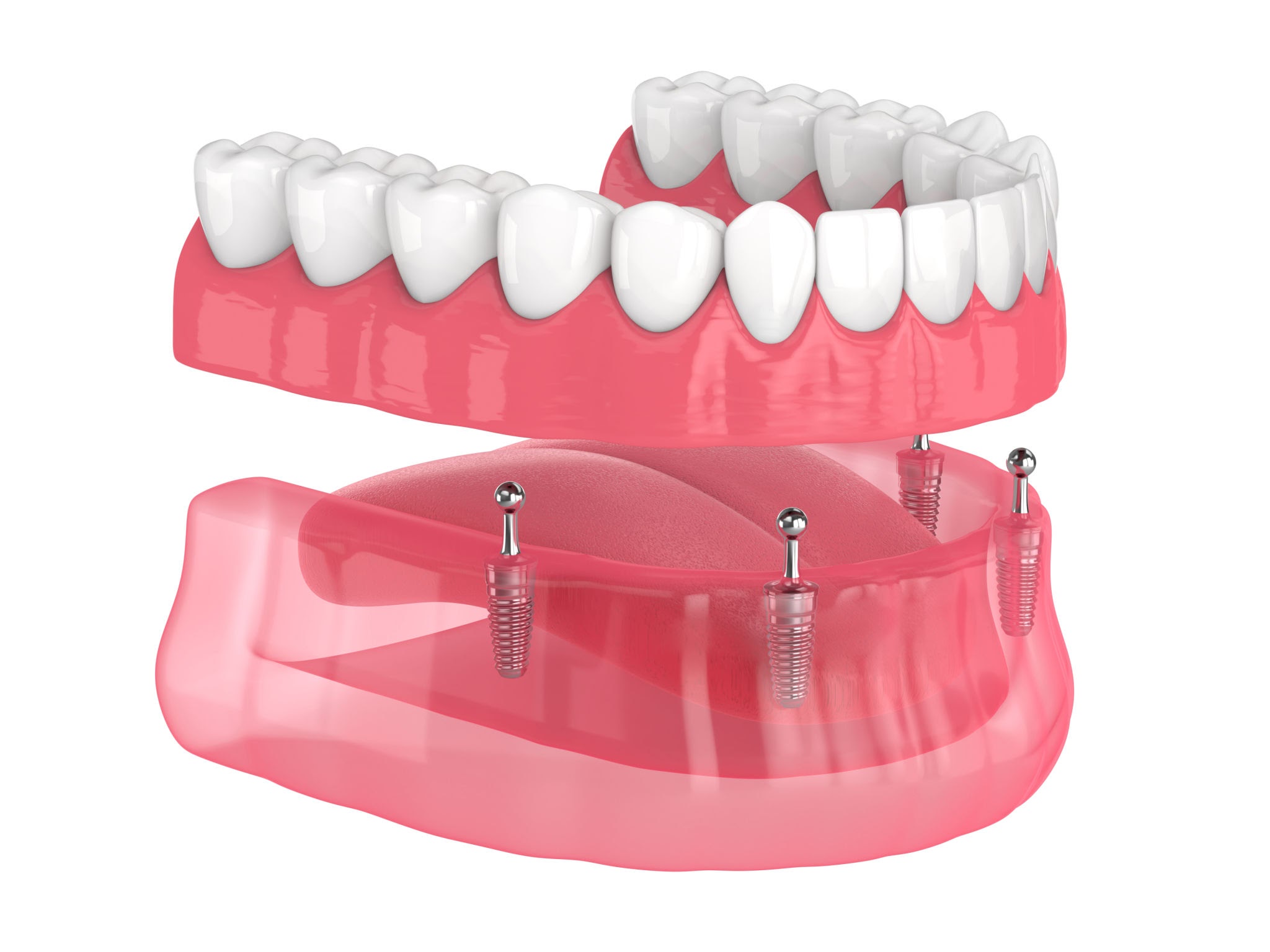 Implantologie dentaire - Remplacement des dents manquantes