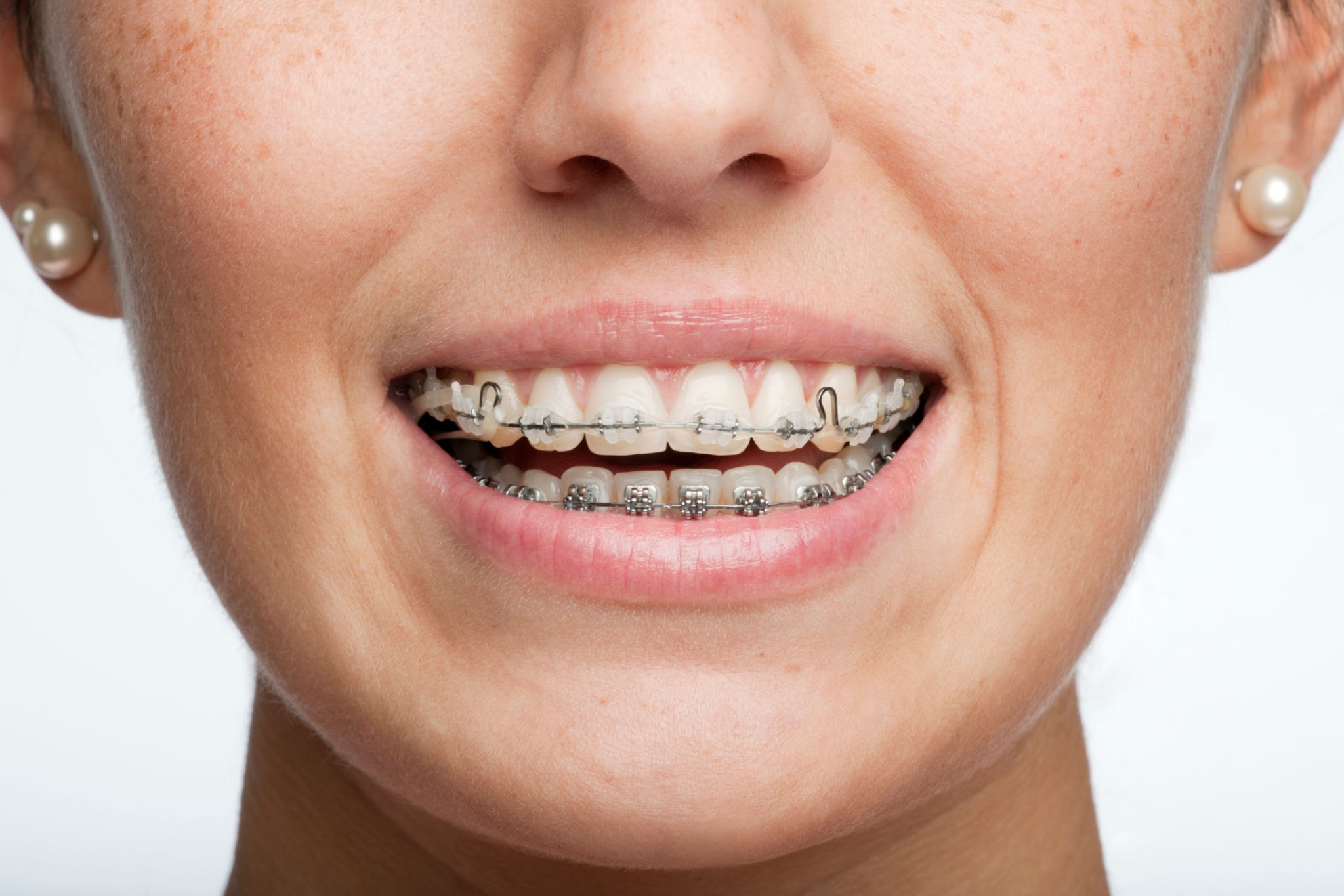 Orthodontie dentaire - Alignement des dents